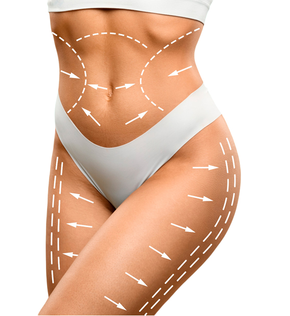 Lipoescultura